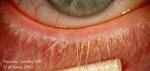 Ocular-Rosacea-Blurry-Red-Itchy_1.jpg